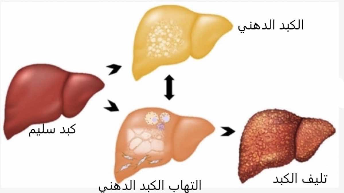 الكبد الدهني