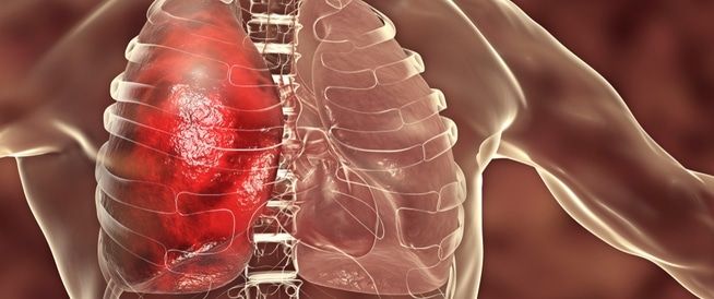 أعراض ناتجة عن مشاكل فى الرئة وليس القلب 